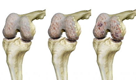 refleksologija u liječenju artroze bolove u zglobovima nakon cijepljenja