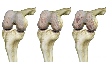 prehrana u liječenju artroze koljena